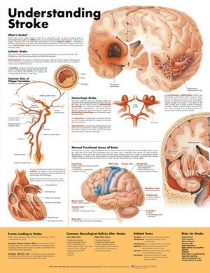 ANATOMICAL CHART COMPANY MT-USTRSL Chart Heavy Paper Understanding Stroke 50cm x 61cm